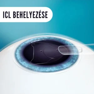 STAAR EVO ICL - ICL szembe ültethető kontaktlencse - látásjavító szemműtét