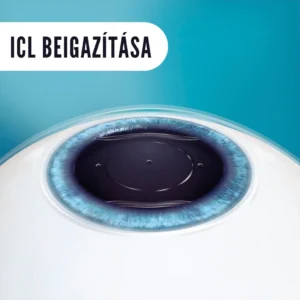 STAAR EVO ICL - ICL szembe ültethető kontaktlencse - látásjavító szemműtét